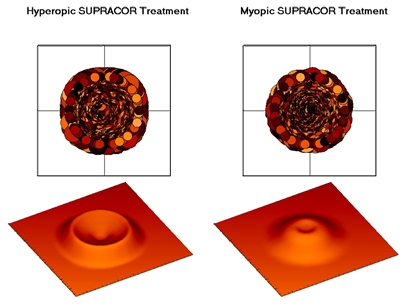 Профили абляции SUPRACOR при гиперметропии и миопии.