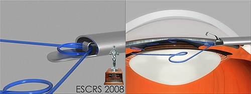 Почетный приз ESCRS в 2008 году
